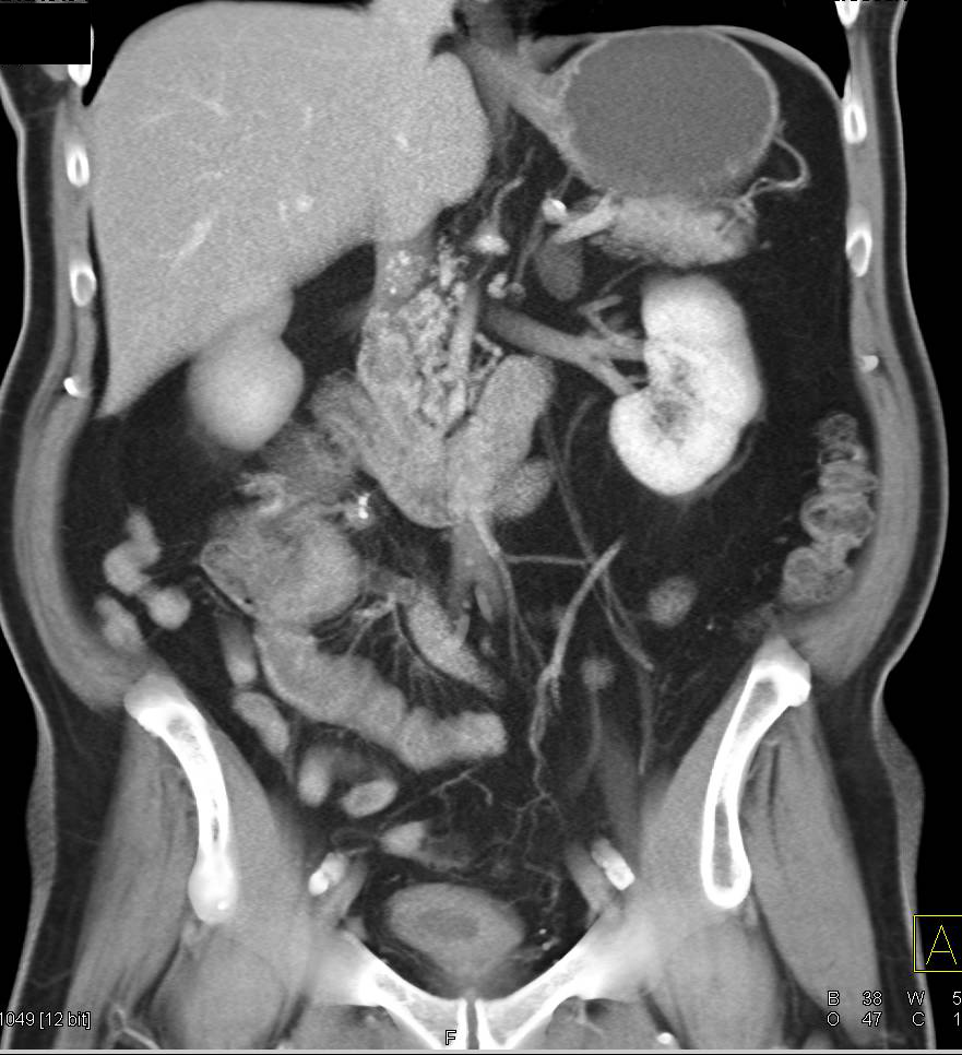 Carcinoid Tumor in the Root of the Mesentery - CTisus CT Scan