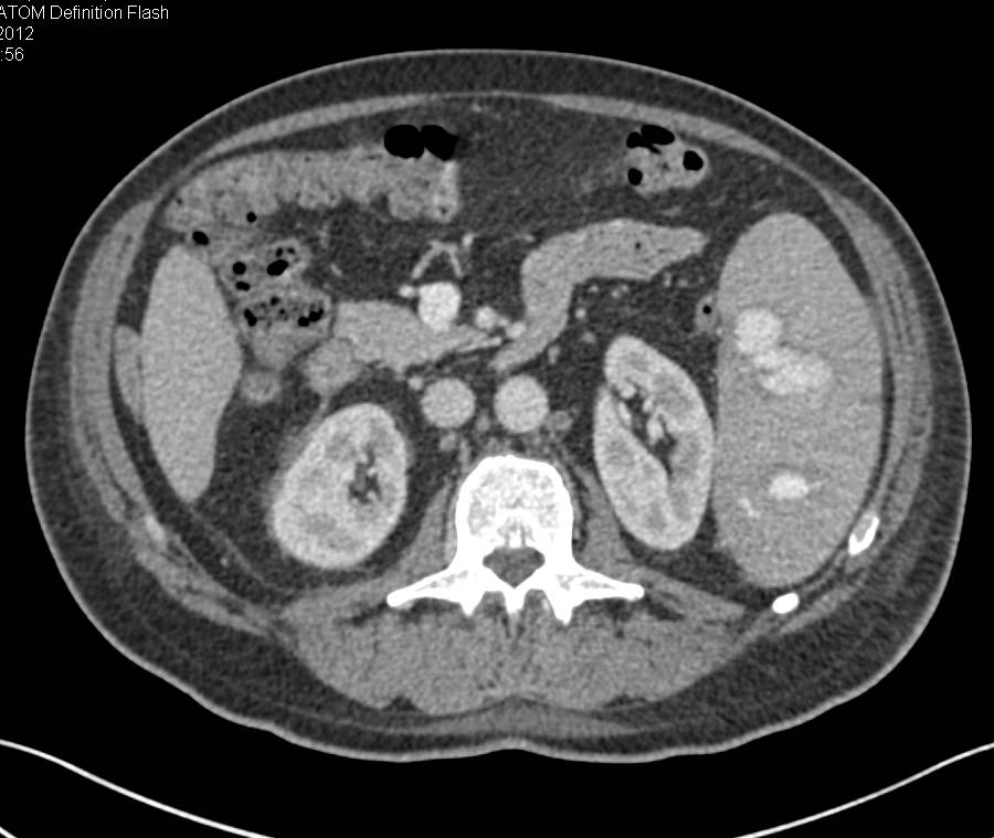 Spontaneous Splenic Bleed Without Trauma - CTisus CT Scan