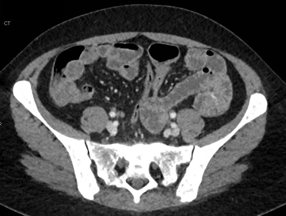 Small Vascular Lesion in Jejunum - CTisus CT Scan