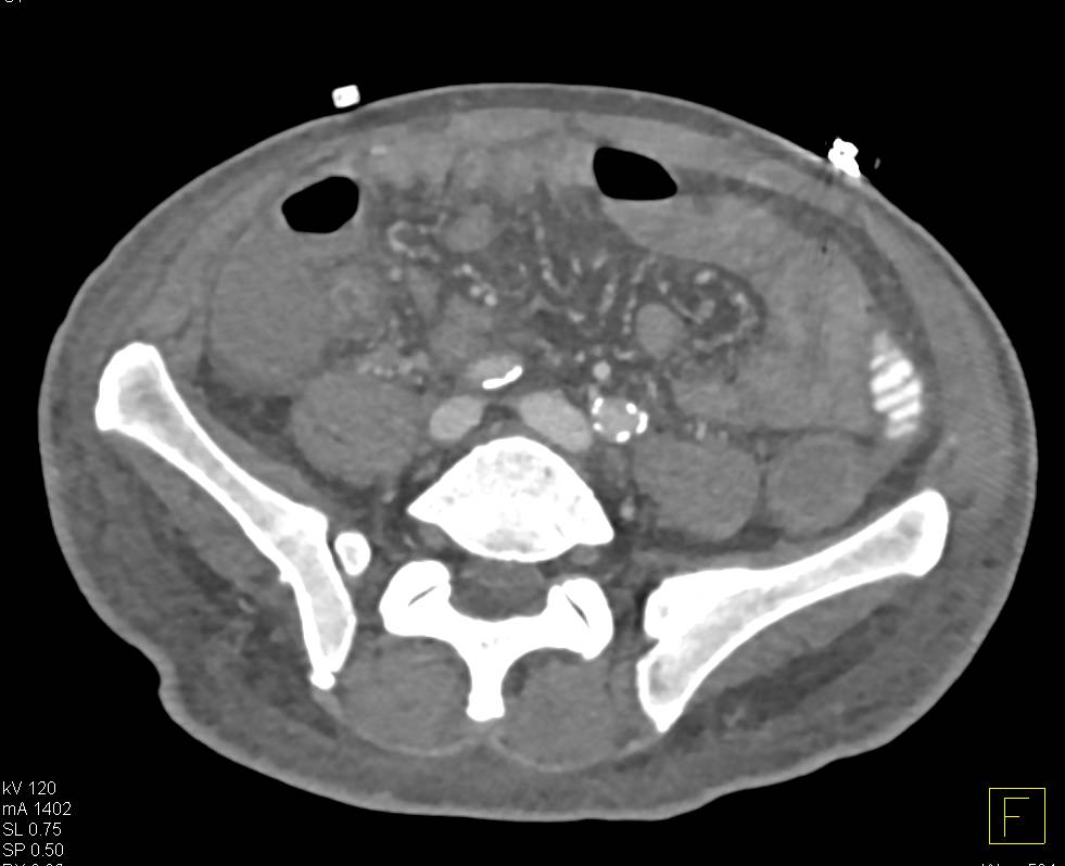 Edematous Small Bowel with Hypoproteinemia - CTisus CT Scan