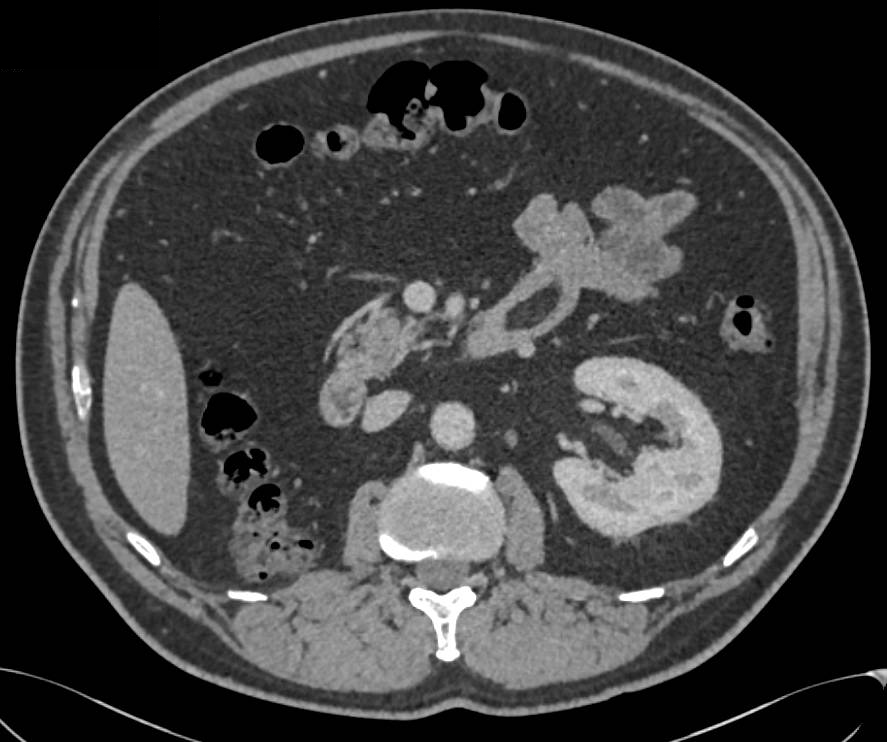 Incidental Duodenal Lipoma - CTisus CT Scan