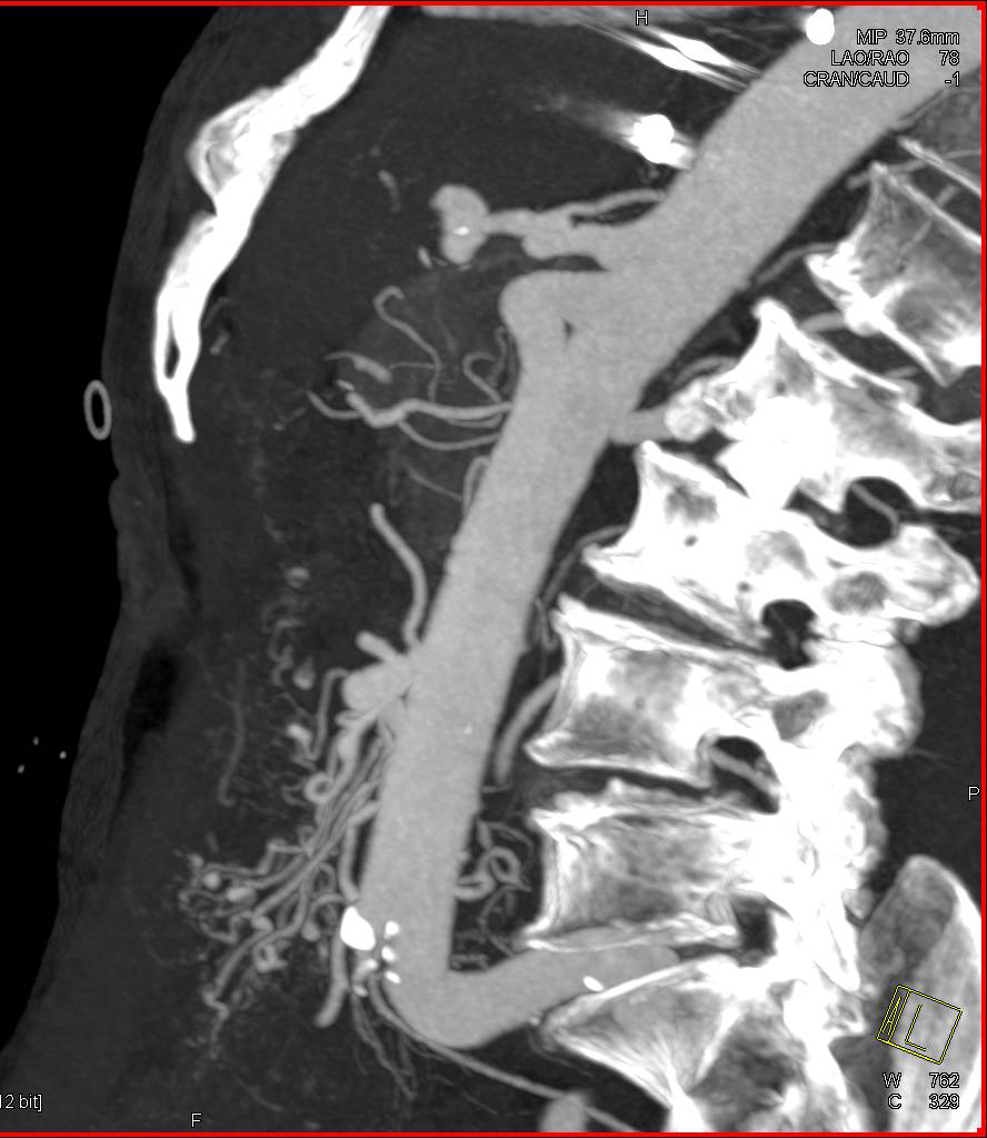 Superior Mesenteric Artery (SMA) with collaterals - CTisus CT Scan