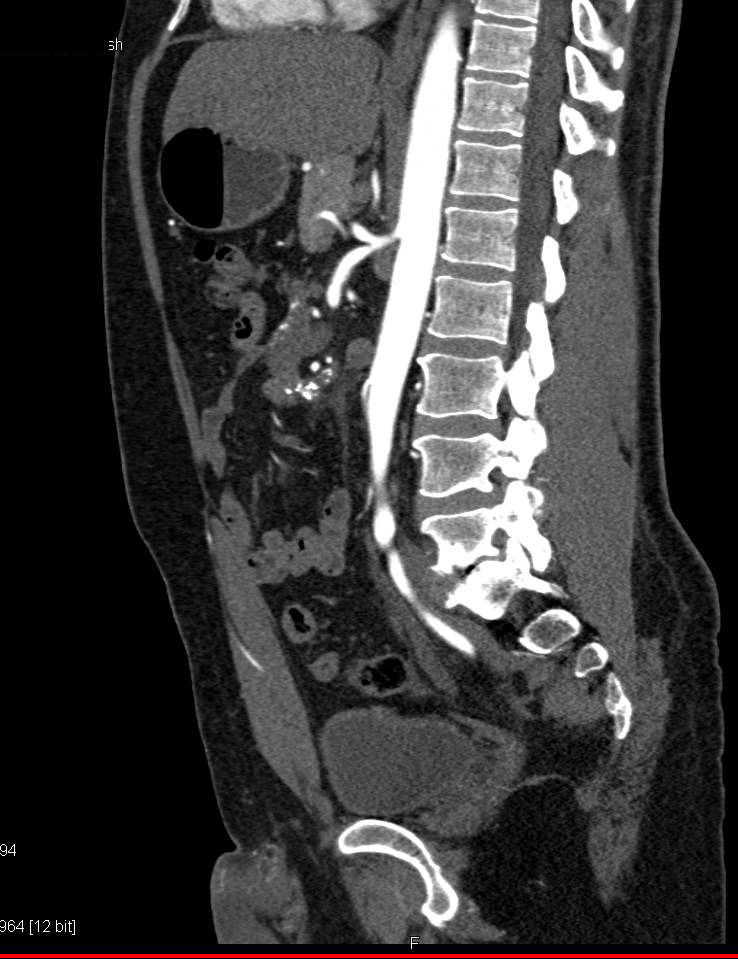 Sclerosing Mesenteritis with Calcified Mesenteric Mass - CTisus CT Scan