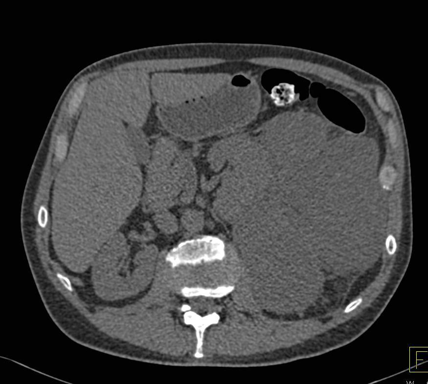 Retroperitoneal Sarcoma - CTisus CT Scan