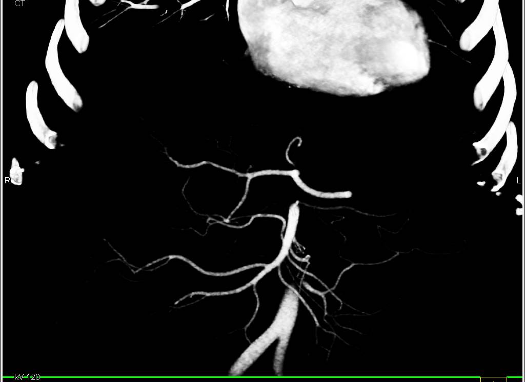 Gastric GIST Tumor - CTisus CT Scan