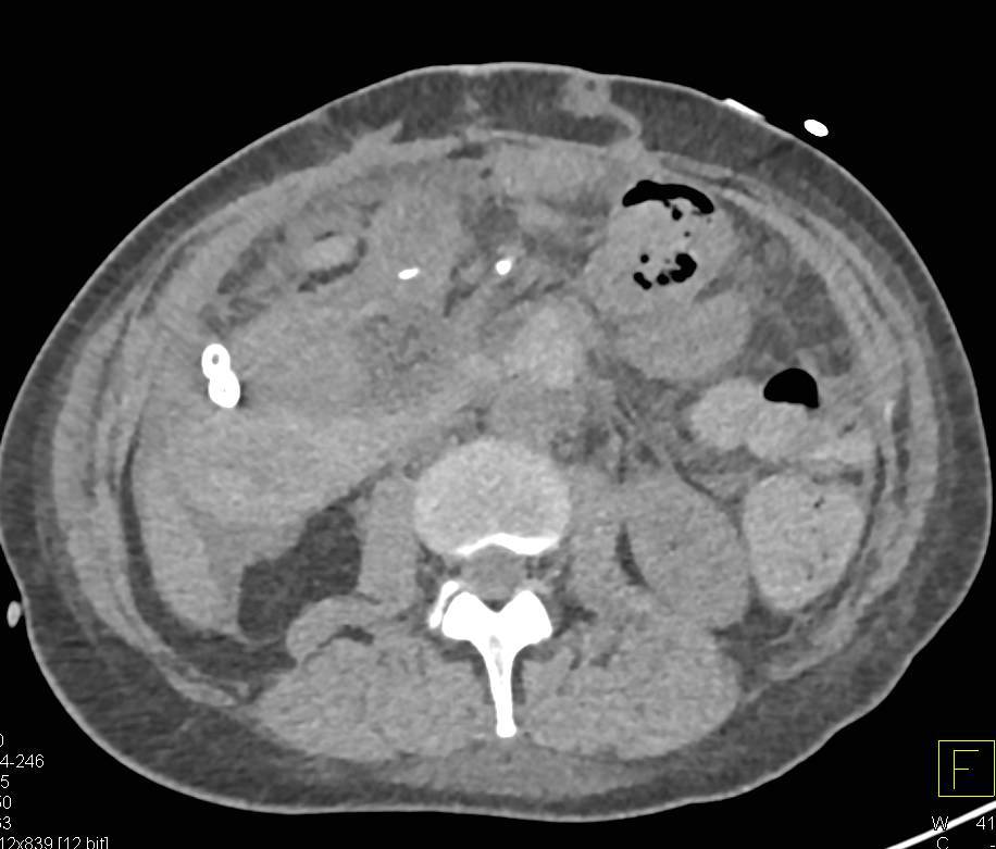 Intraperitoneal Bleed s/p Whipple Procedure - CTisus CT Scan