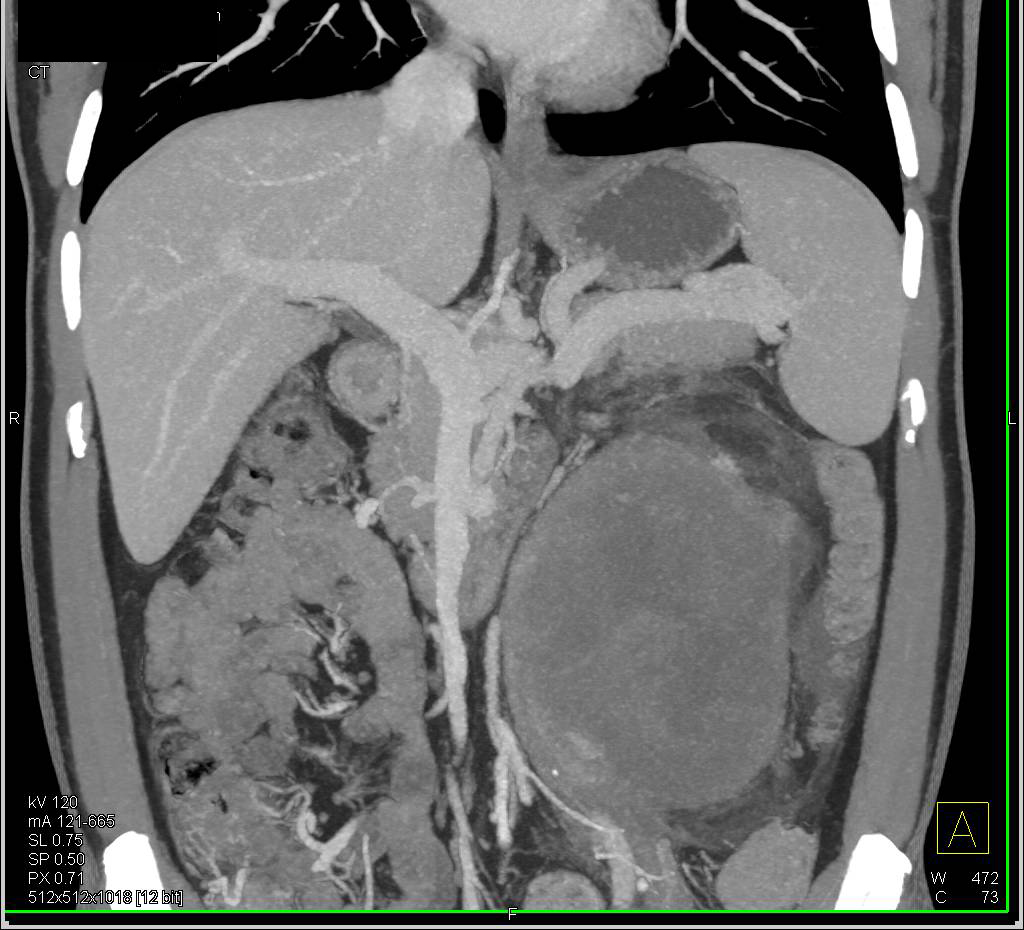 Germ Cell Tumor - CTisus CT Scan