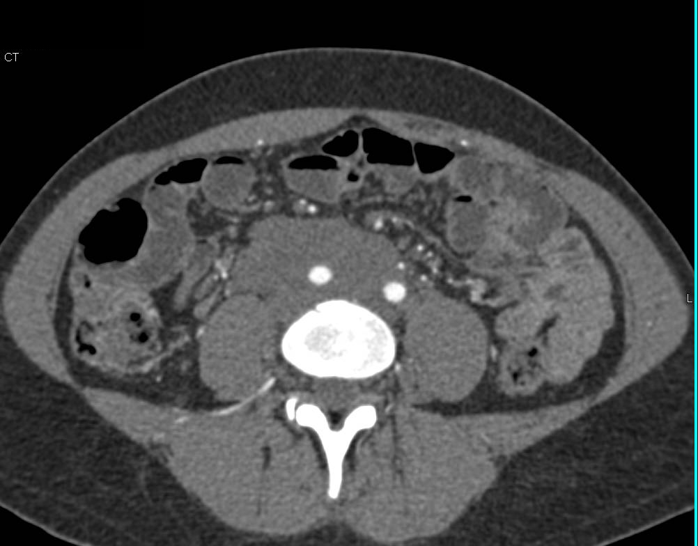 Unusual Appearance of Retroperitoneal Fibrosis - CTisus CT Scan