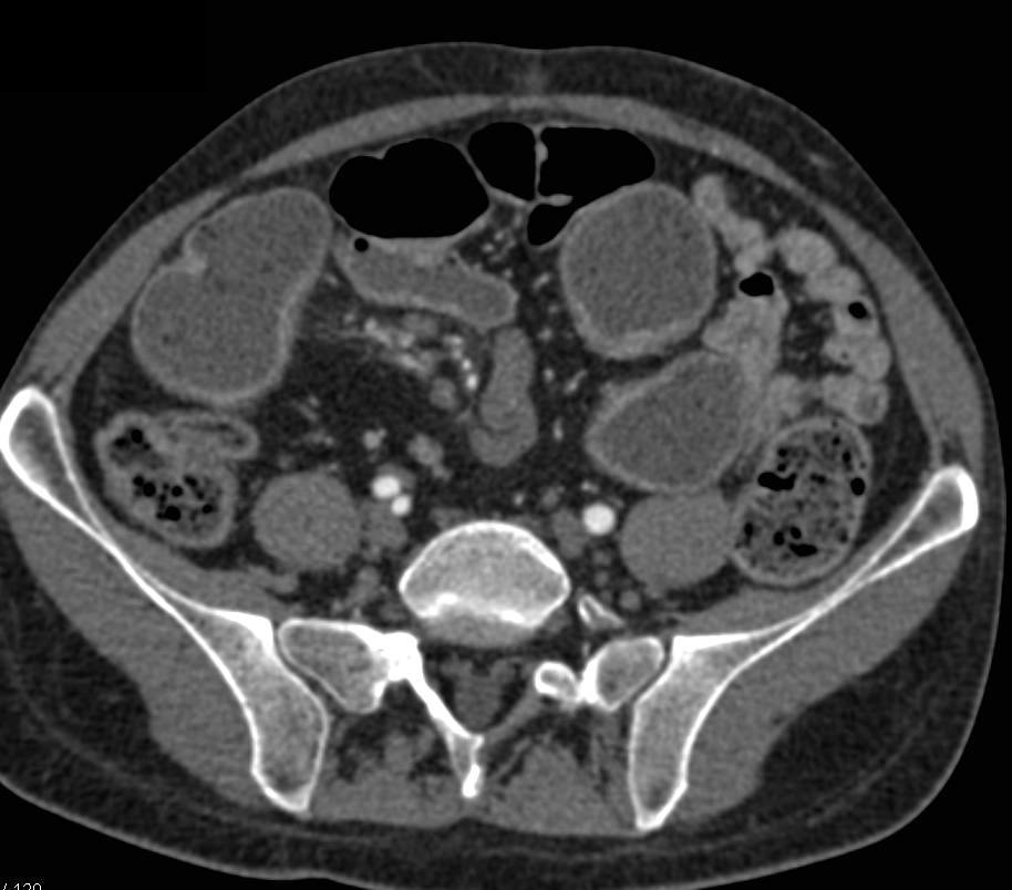 Crohn's Disease with Thickened Ileum and Strictures and Prominent Vasa Recta - CTisus CT Scan