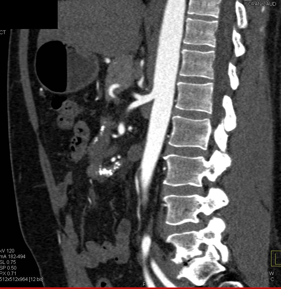 Sclerosing Mesenteritis with Calcified Mesenteric Mass in Root of Mesentery - CTisus CT Scan