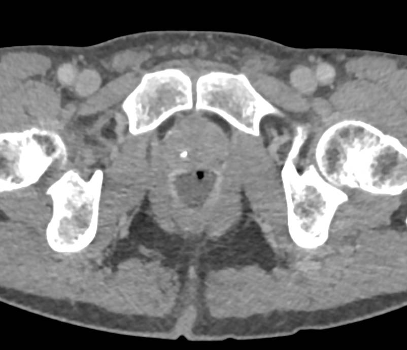 Colitis Involves Lower Rectum with Enhancement and Dilated Fluid Filled Colon - CTisus CT Scan