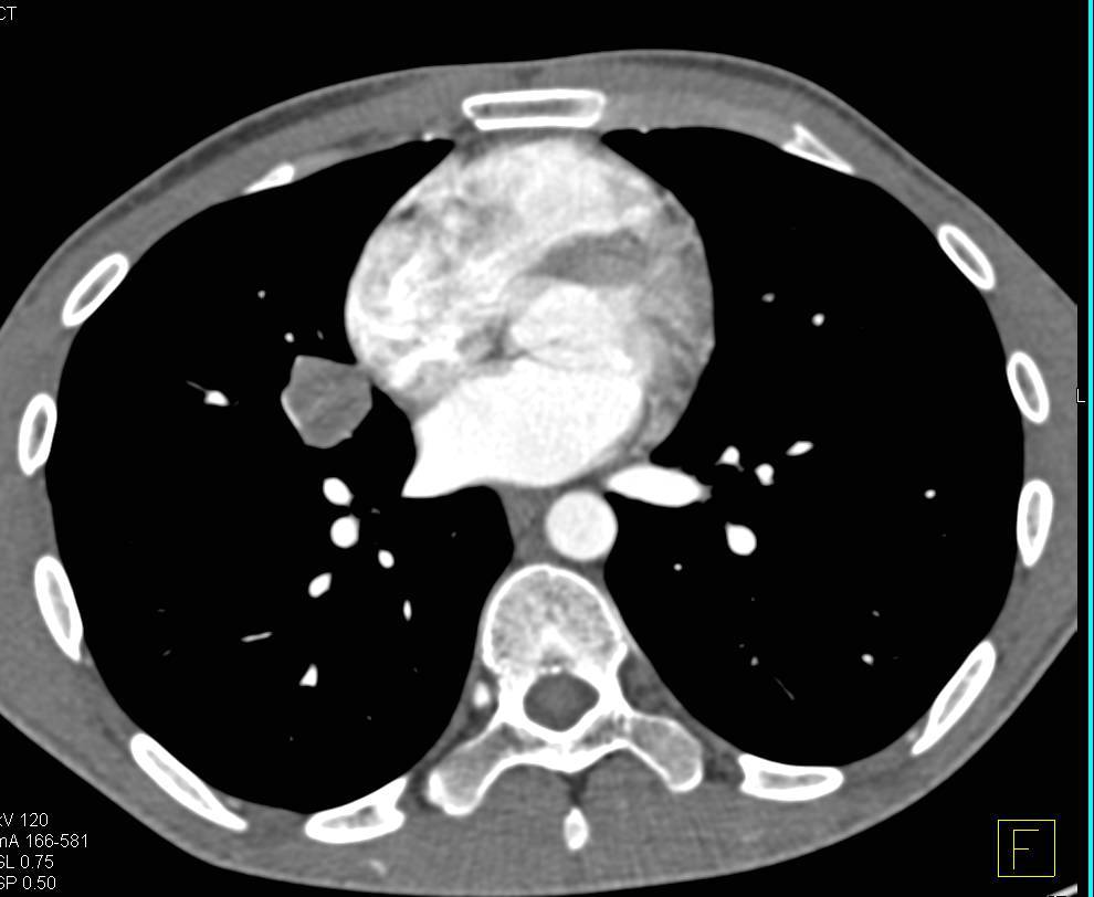 Metastatic GIST Tumor to the Liver Best Seen on Venous Phase Images - CTisus CT Scan