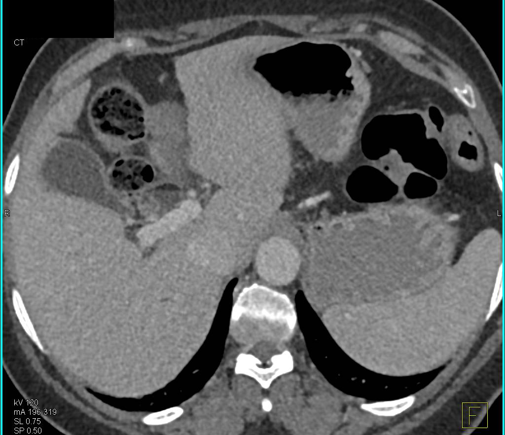 Fat-fluid Level in Common Bile Duct (CBD) Following Gallbladder Resection - CTisus CT Scan