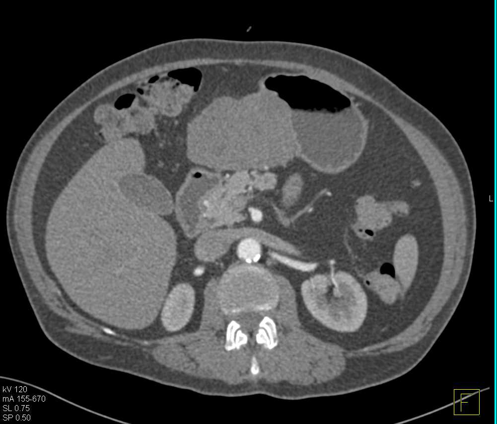 Exophytic Gastric GIST Tumor - CTisus CT Scan