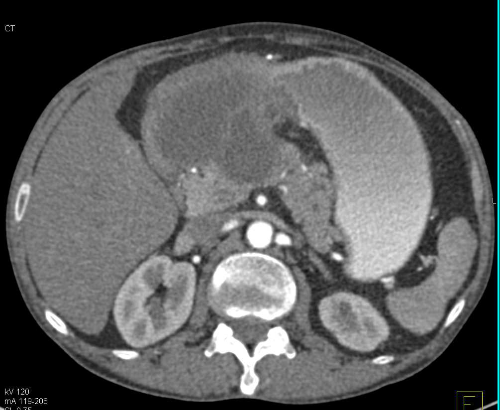 Gastric GIST Tumor - CTisus CT Scan