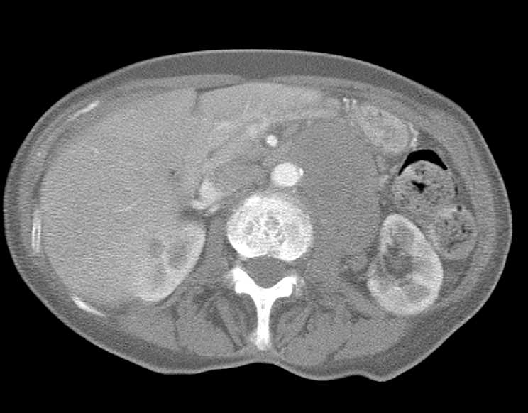 Retroperitoneal Neurosarcoma - CTisus CT Scan