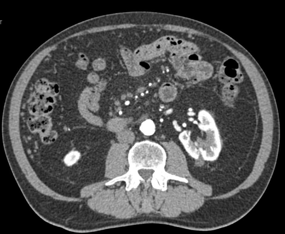 Neuroendocrine Tumor of the Pancreas is Hypervascular and Invades the Portal Vein - CTisus CT Scan