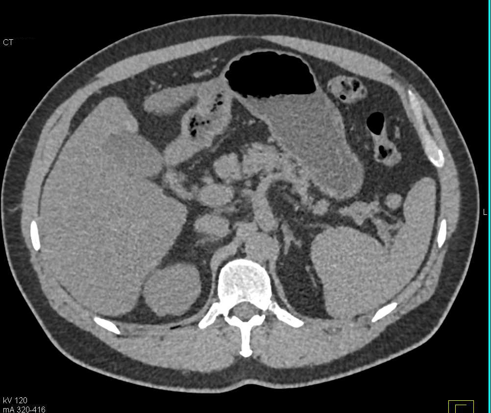 Ehlers-Danlos Syndrome with Involvement of the Mesenteric Arteries with Superior Mesenteric Artery (SMA) Dissections and Beading - CTisus CT Scan