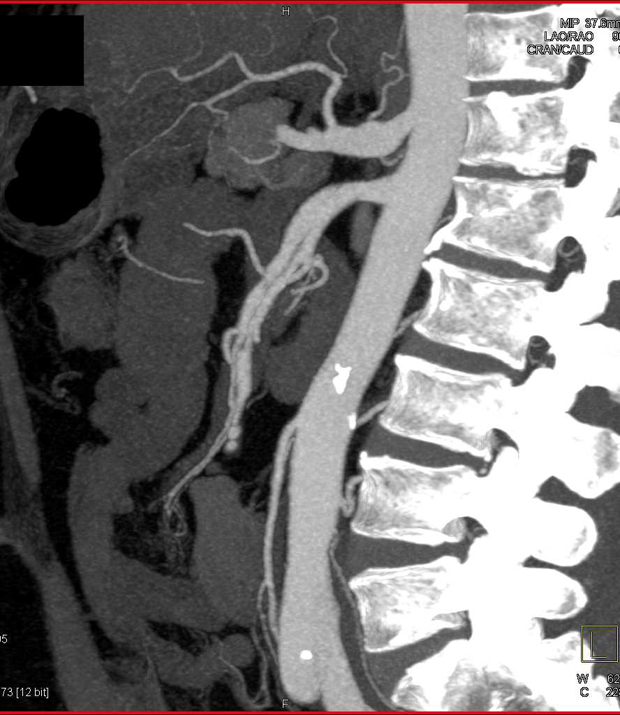 Vasculitis with Multiple Superior Mesenteric Artery (SMA) Dissections - CTisus CT Scan