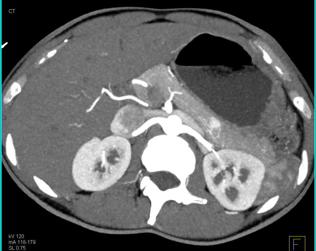 1 cm Neuroendocrine Tumor in Body of Pancreas Seen Only on Arterial Phase Imaging - CTisus CT Scan