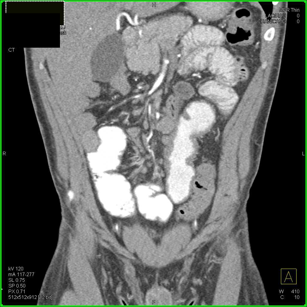 Crohn's Disease Involves the Rectum - CTisus CT Scan