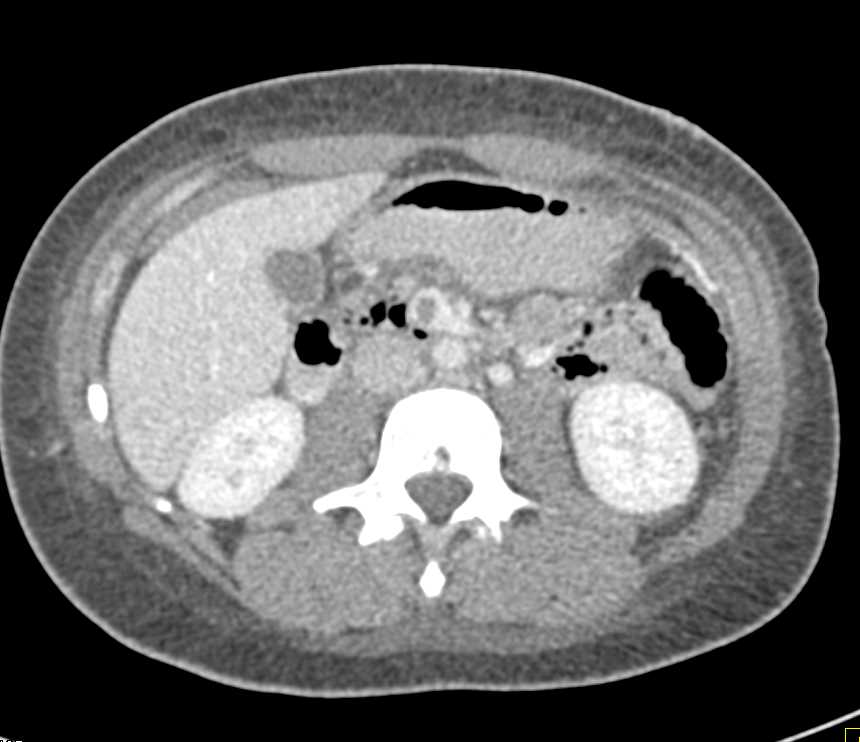 Superior Mesenteric Vein (SMV) Clot and Pneumoperitoneum - CTisus CT Scan