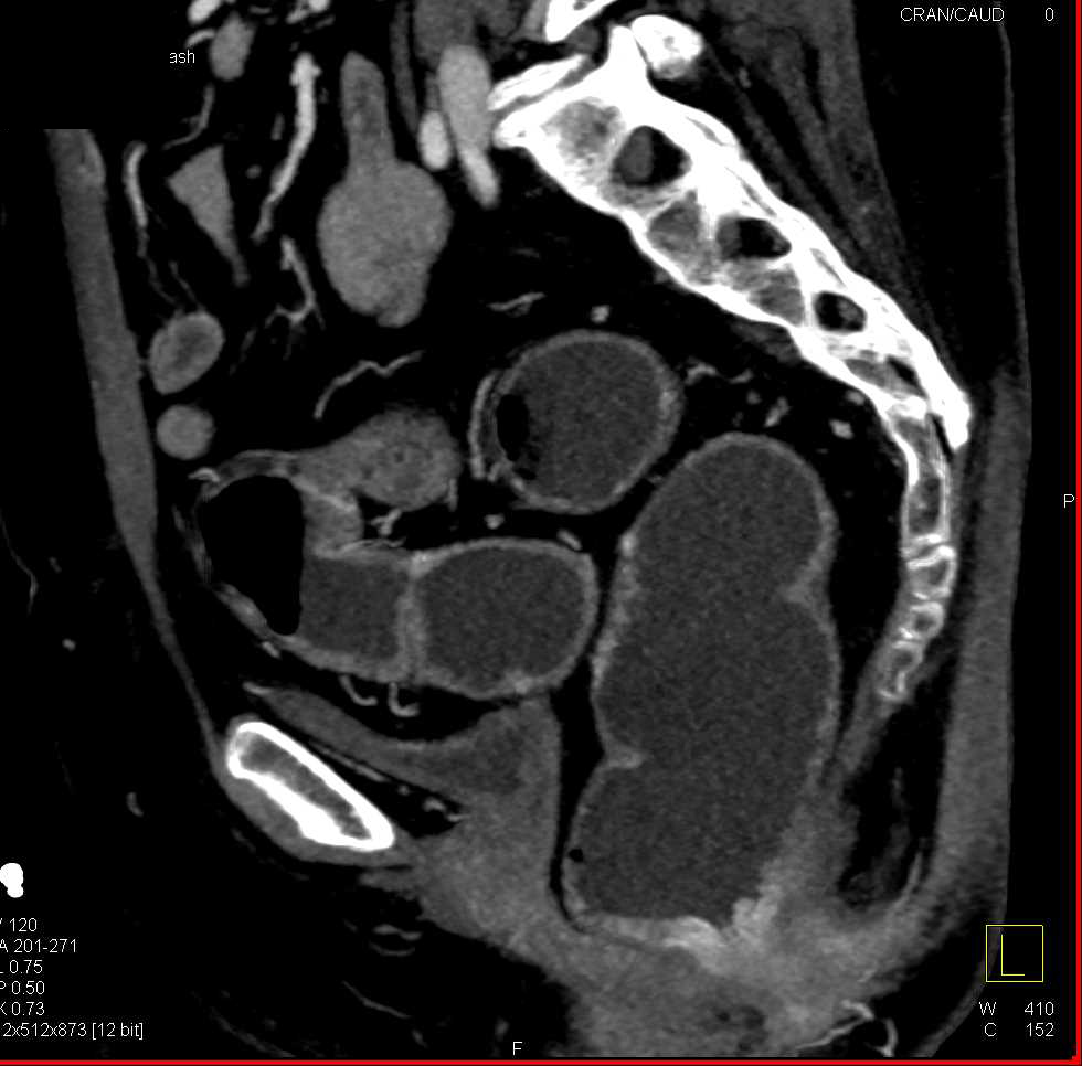 Crohn's Colitis Colon Including the Rectum with CTA - CTisus CT Scan