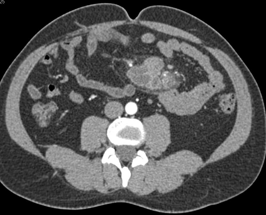 Mycobacterium avium/intracellulare (MAI) with Necrotic Nodes in the Mesentery - CTisus CT Scan