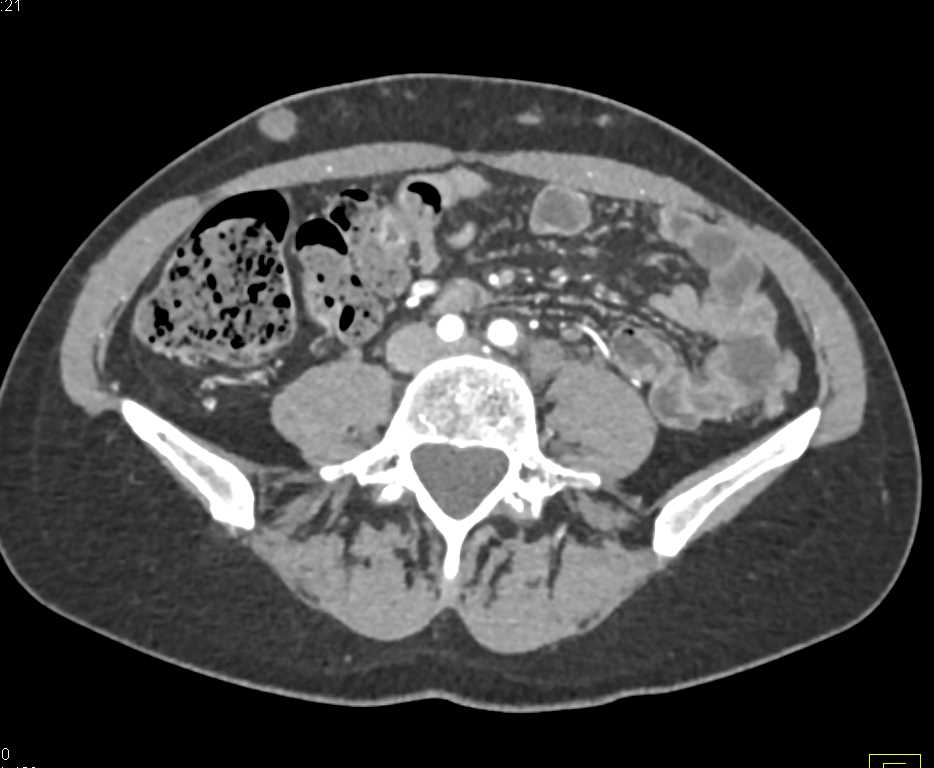 Metastatic Melanoma with a Range of Implants - CTisus CT Scan