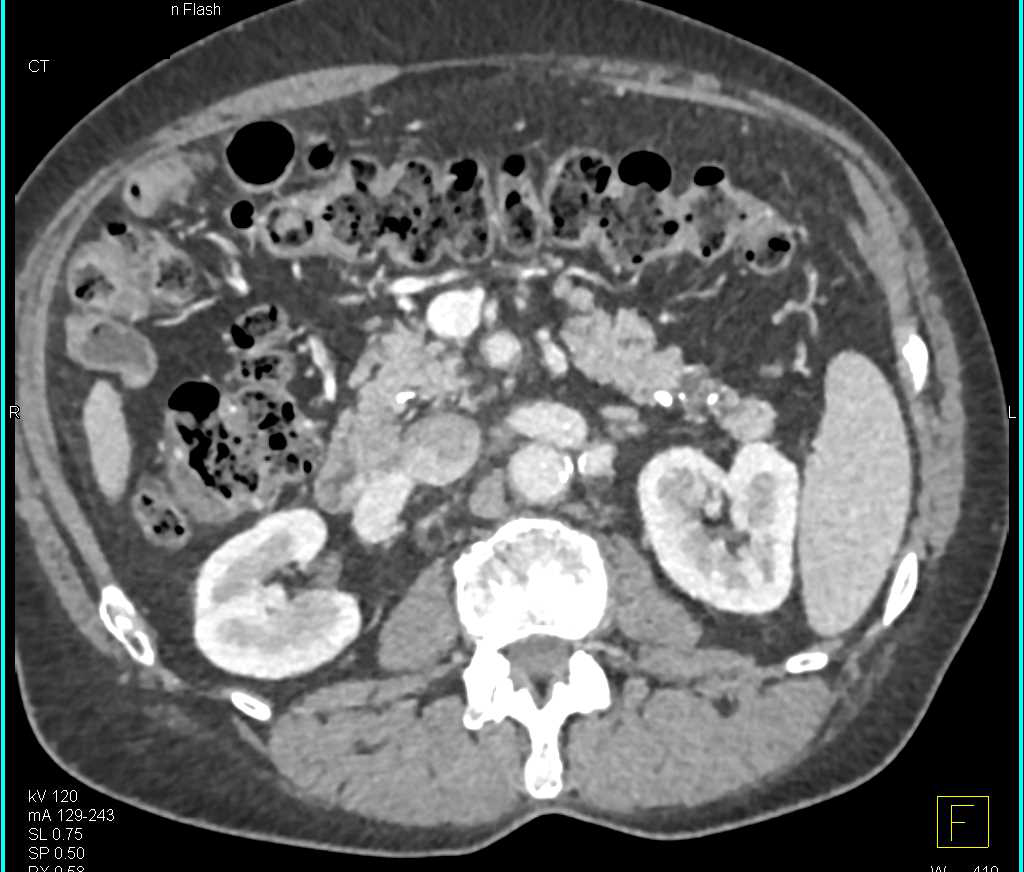 Chronic Pancreatitis with Pseudocyst - CTisus CT Scan