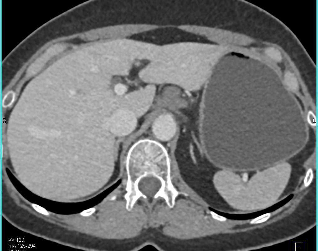 Unusual Benign Cyst Near Celiac Artery - CTisus CT Scan