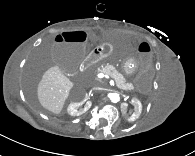 Stent in Superior Mesenteric Artery (SMA) with Aneurysm More Distally - CTisus CT Scan