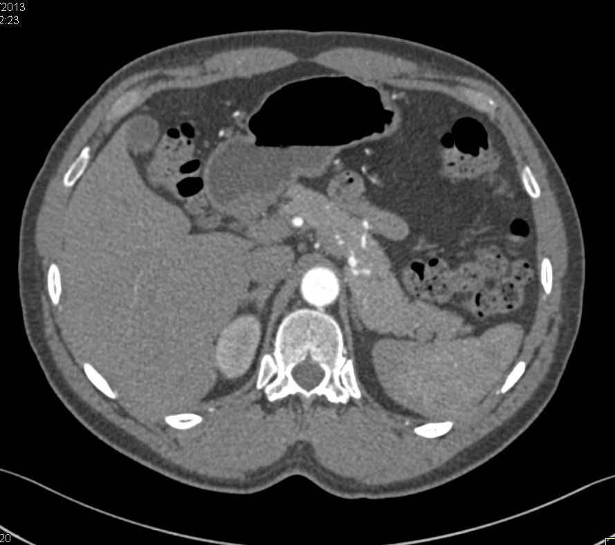 Sclerosing Mesenteritis - CTisus CT Scan