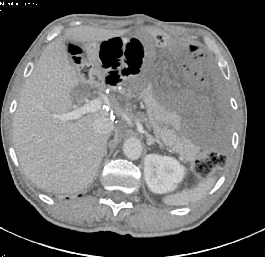 Internal Hernia within Left Upper Quadrant - CTisus CT Scan