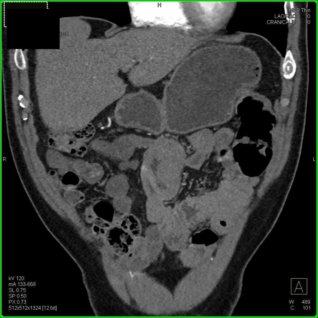 Small Bowel Adenocarcinoma - CTisus CT Scan