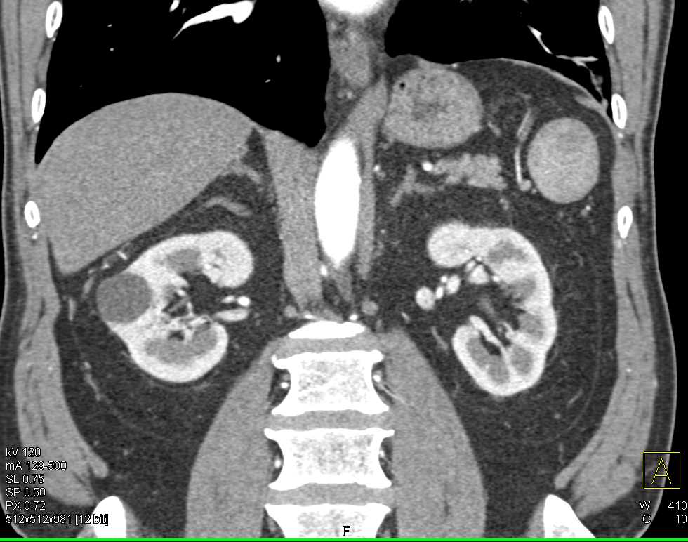 Multiple Accessory Spleens in Patient s/p Splenectomy - CTisus CT Scan