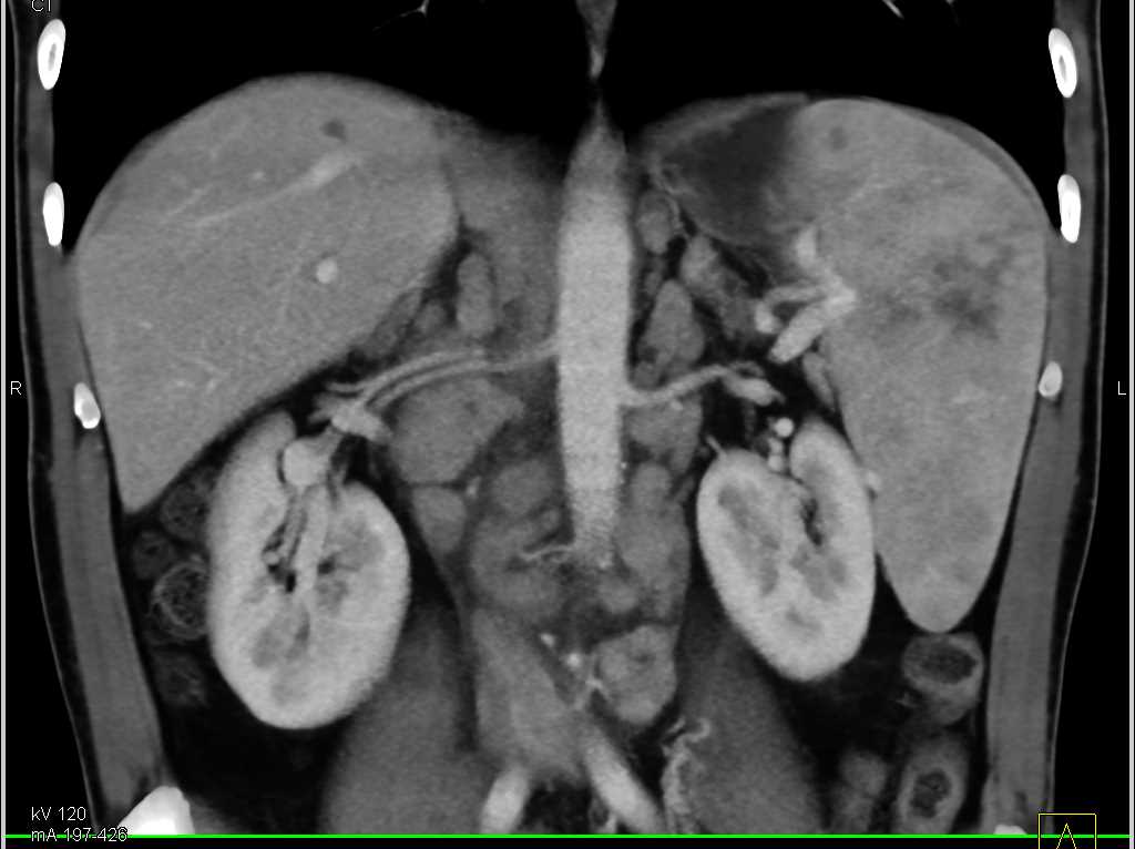 Lymphoma with Splenic Involvement and Extensive Adenopathy - CTisus CT Scan