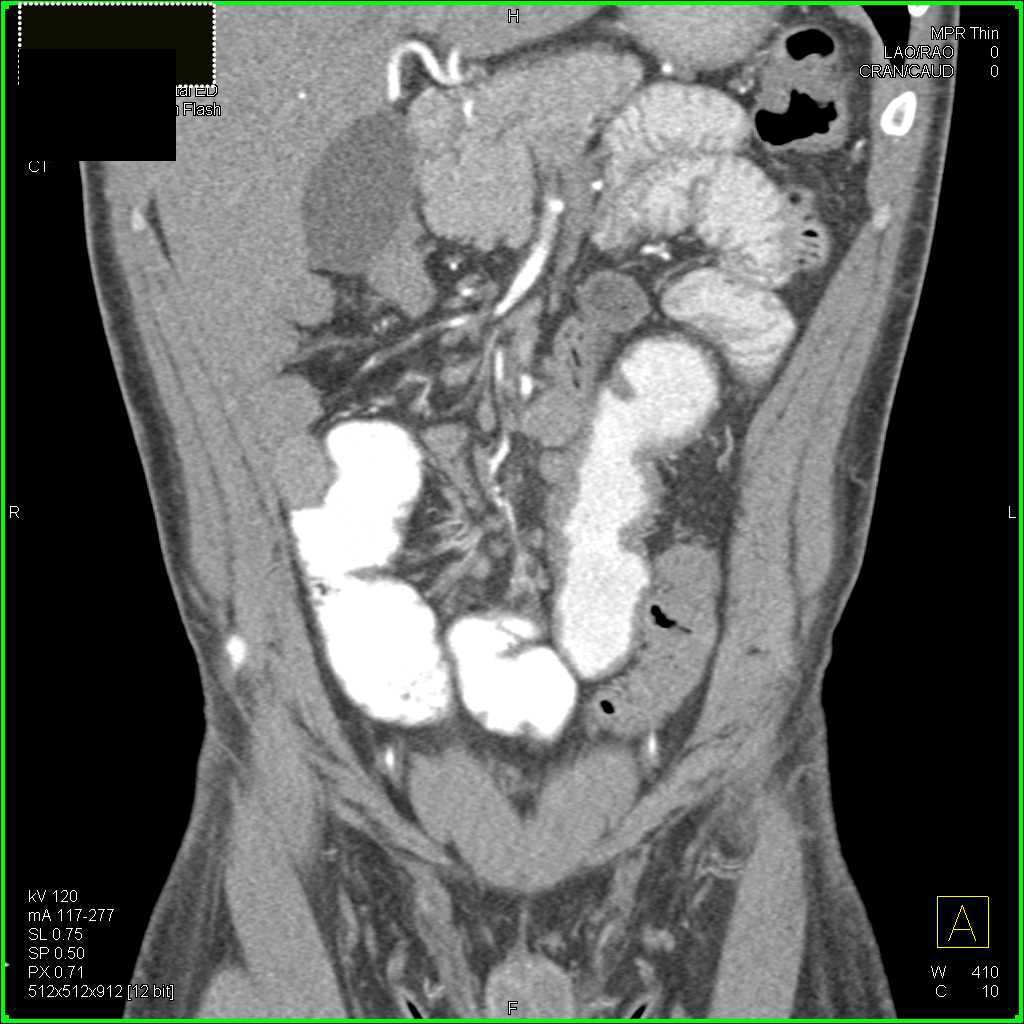 Ulcerative Colitis Involving Rectum - CTisus CT Scan