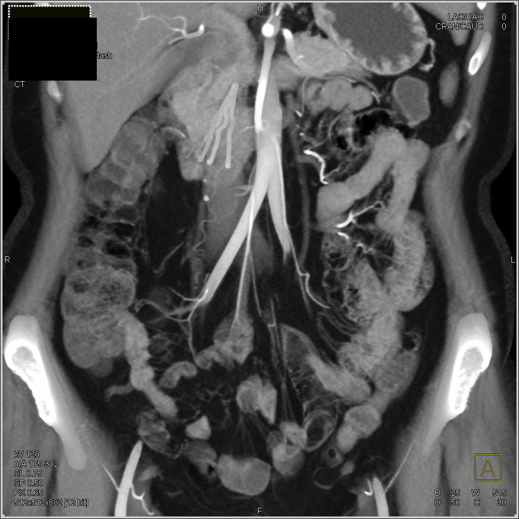 Pancolitis Nicely Seen in 3D VRT with Large Rectal Varices - CTisus CT Scan