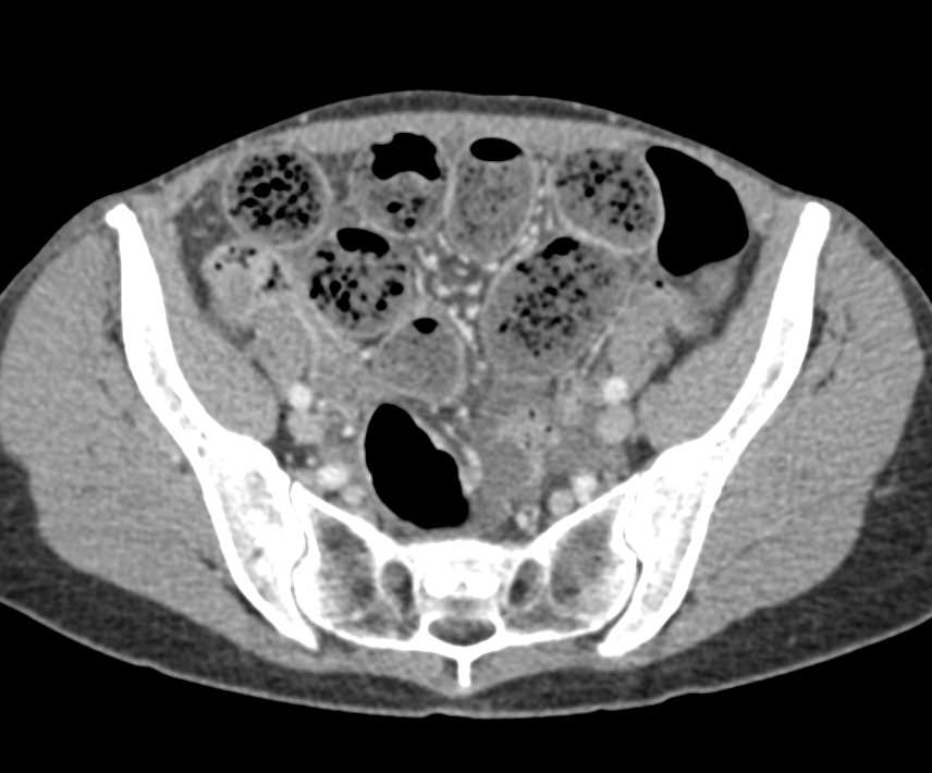 Small Bowel Obstruction with the Feces Sign - CTisus CT Scan