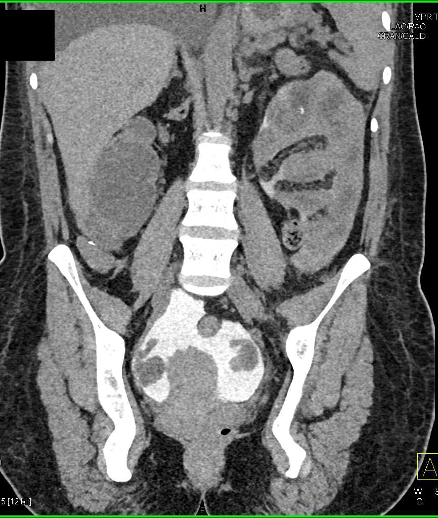 CT Cystogram with Leak Following Renal Transplant. Leak is Large - CTisus CT Scan