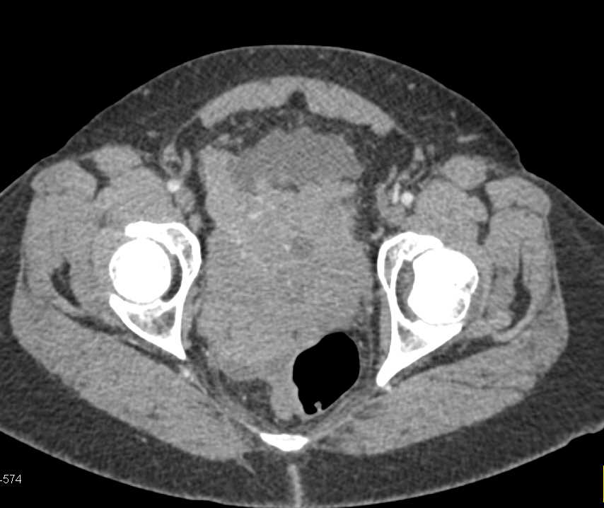 Carcinomatosis with Implants in Abdomen and Pelvis - CTisus CT Scan