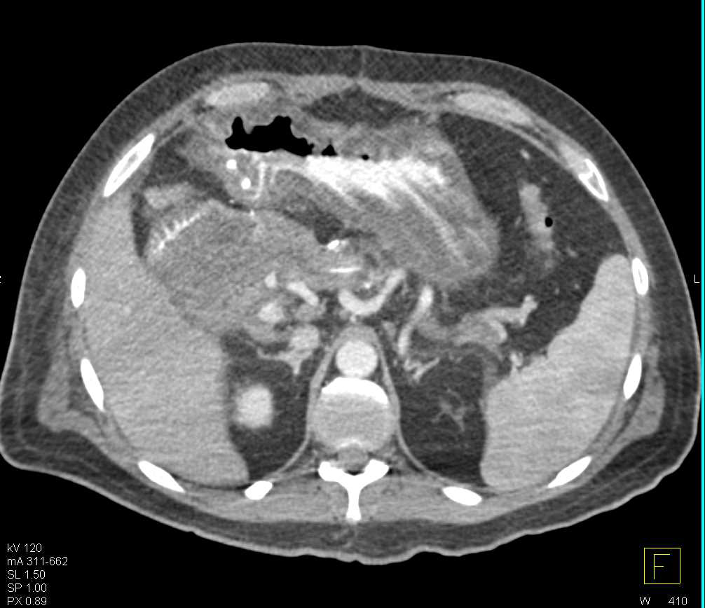 Clot in Gastrojejunostomy In Afferent Limb - CTisus CT Scan