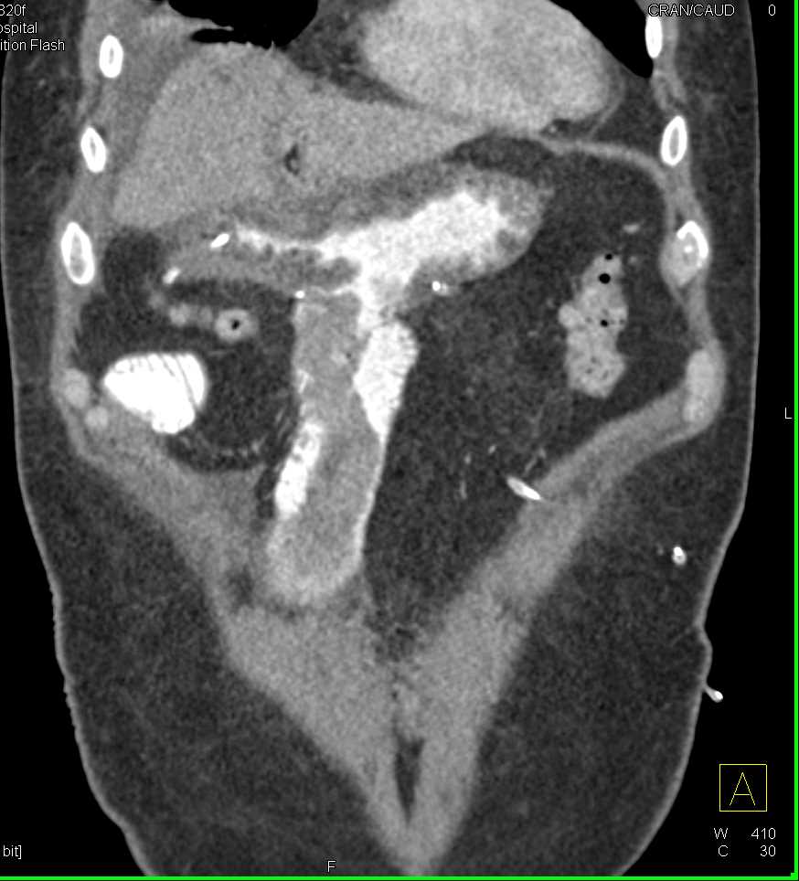 Clot in Gastrojejunostomy In Afferent Limb - CTisus CT Scan