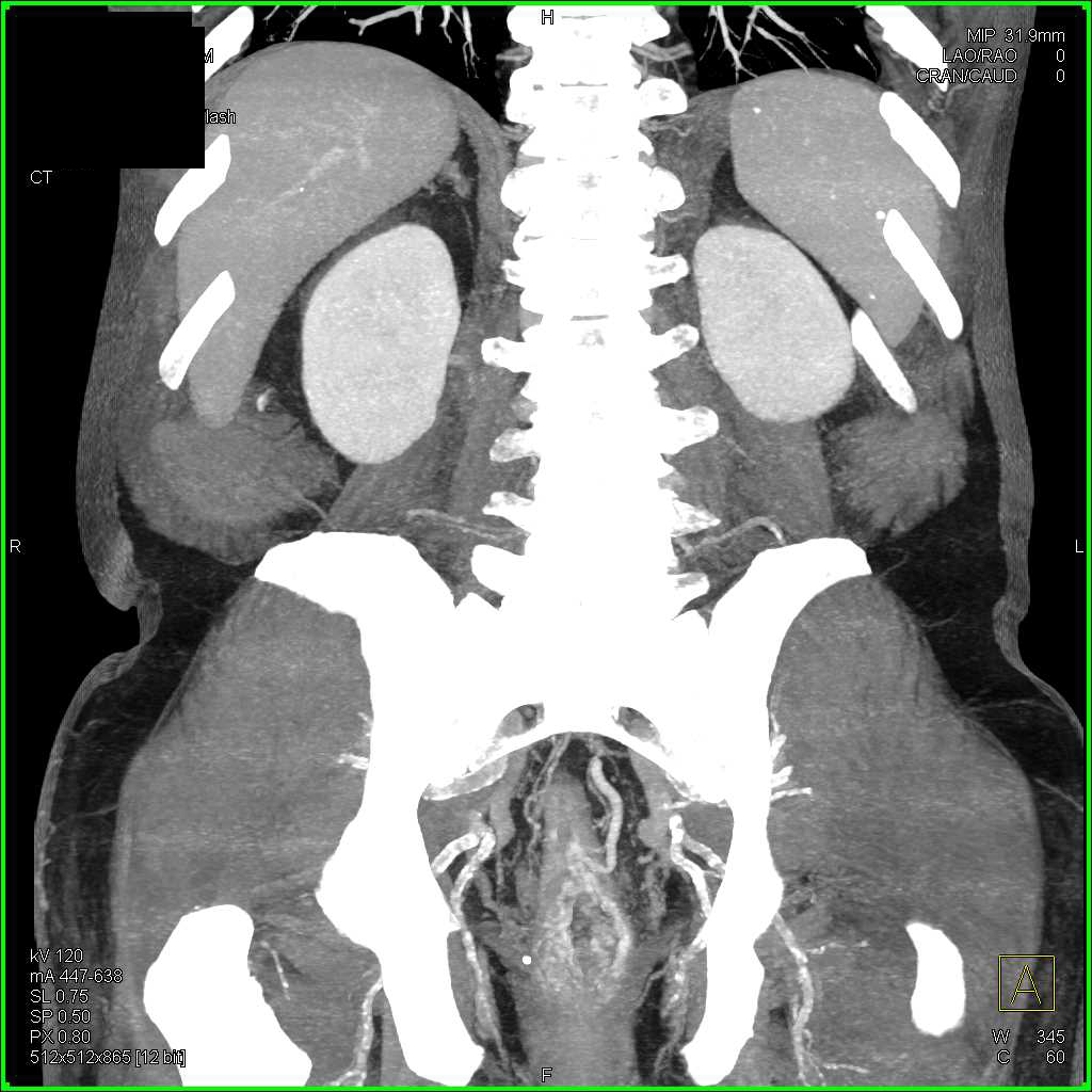 Carcinoma of the Rectum and Sigmoid Colon - CTisus CT Scan