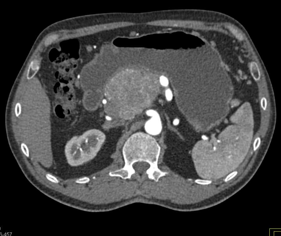 Atypical Neuroendocrine Tumor of the Head of the Pancreas - CTisus CT Scan