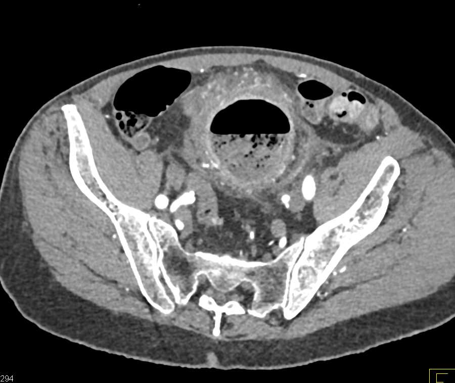 Pelvic Abscess - CTisus CT Scan