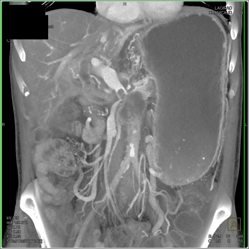 Pancreatic Cancer Encases the Portal Vein and Superior Mesenteric Vein (SMV) and  Splenic Vein - CTisus CT Scan