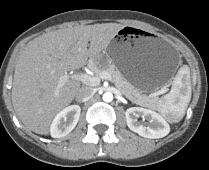 Normal Post Whipple Procedure CT - CTisus CT Scan