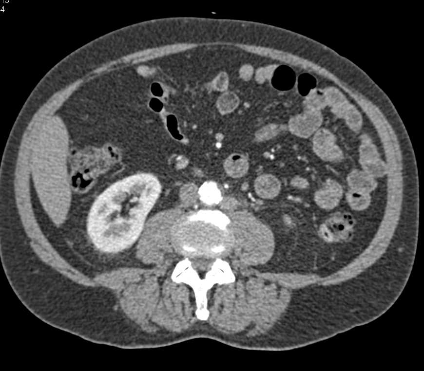 Recurrent Neuroendocrine Tumor with Adenopathy - CTisus CT Scan